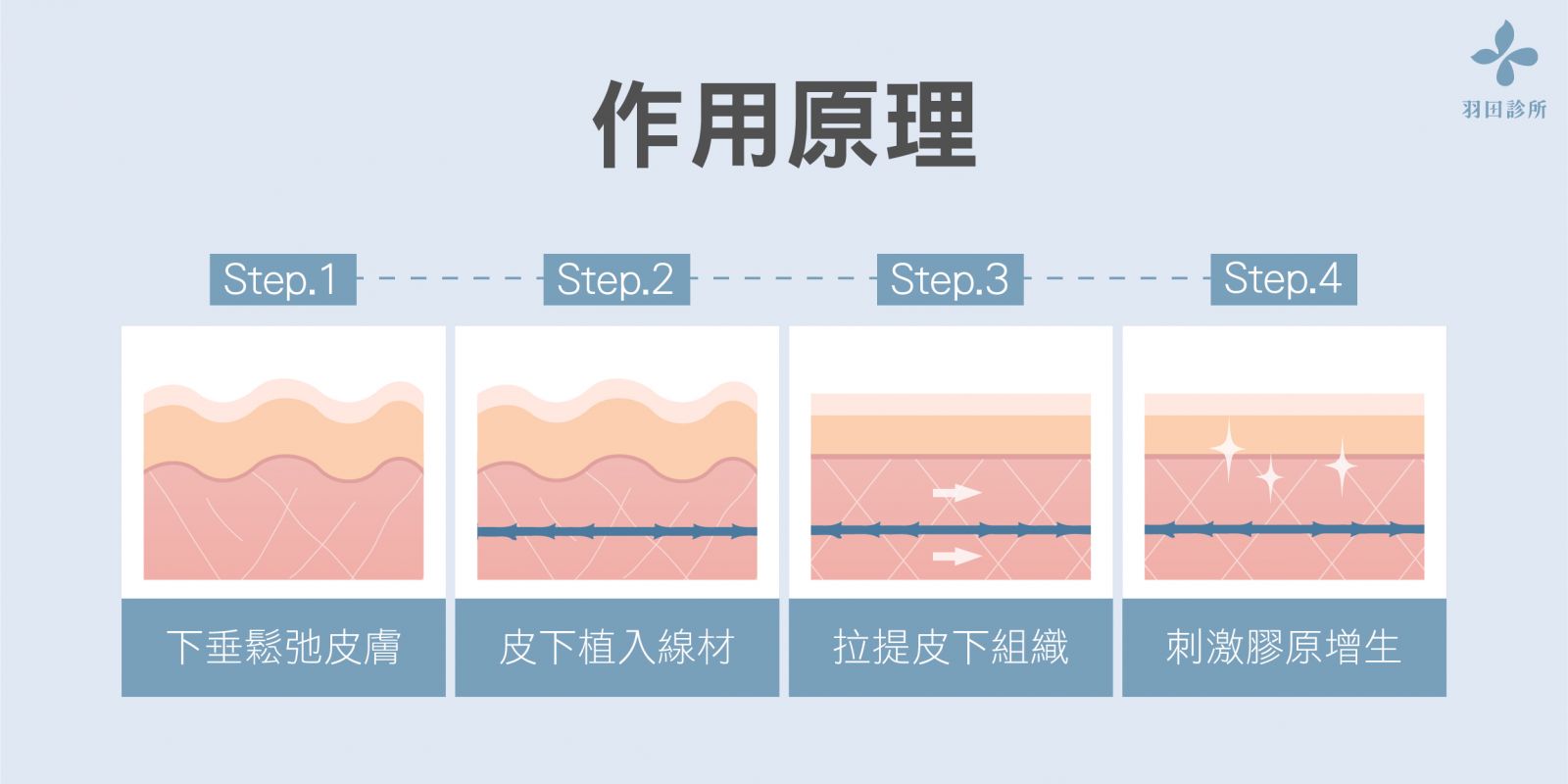 台北羽田診所院長吳佩謙醫師解釋埋線拉提作用原理