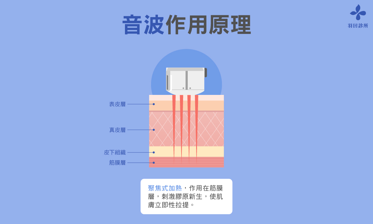 羽田診所吳佩謙醫師製圖說明音波拉提作用原理