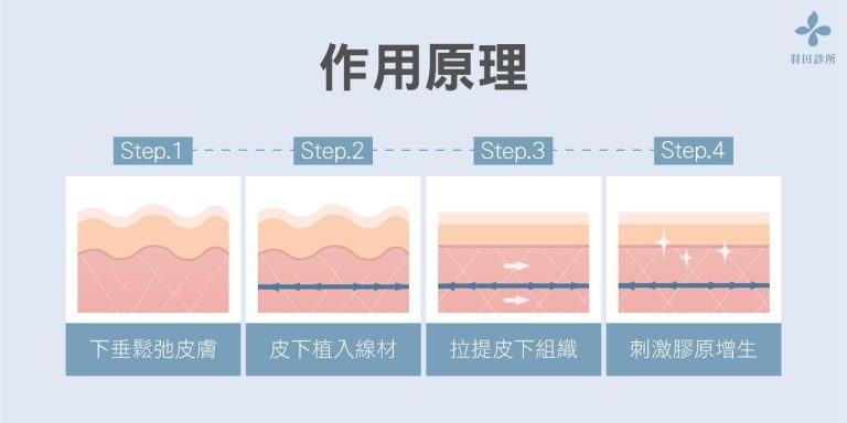 羽田診所吳佩謙醫師說明埋線拉提作用原理