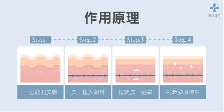 羽田診所吳佩謙醫師說明埋線拉提的作用原理