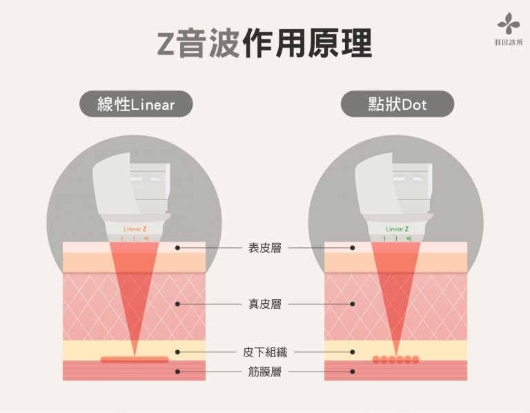 羽田診所吳佩謙醫師製圖說明Z音波作用原理